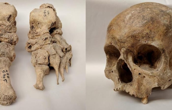 Science: Leprosy DNA extracted from medieval skeletons in Denmark