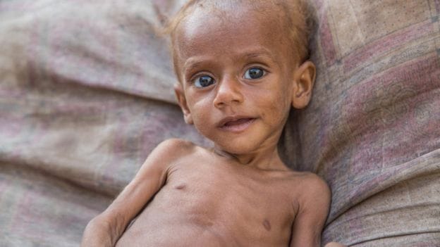 Yemen famine: 85,000 children ‘dead from malnutrition’